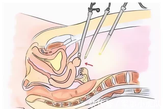 子宫|准备移植胚胎了，还需要做宫腔镜吗？