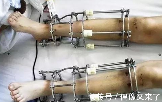 落选|因身高过低自卑,花16万断骨增高7.2厘米的李亚诺,后来怎样了?