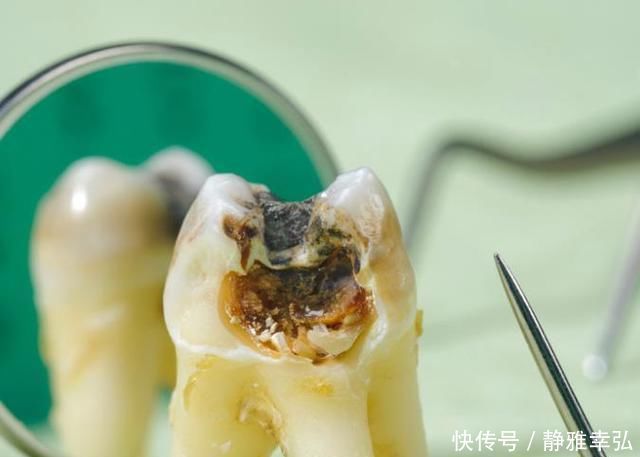 吃糖|10个5岁儿童中，7个有龋齿，罪魁祸首居然不是糖？