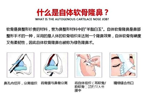 肋软骨 想做隆鼻手术，医生居然要取我的肋骨？