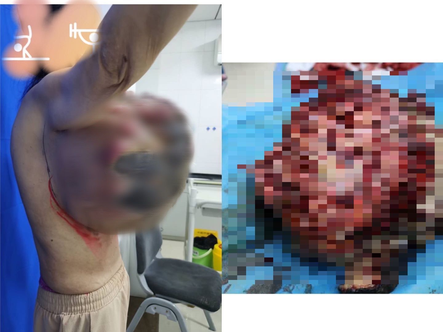 手术|11.9公斤！西北地区没人做过如此巨大肿瘤的手术，他们成功了