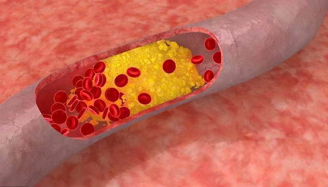 血管堵塞的人,早上会出现3种情况,若没有,恭喜血管保养的很好