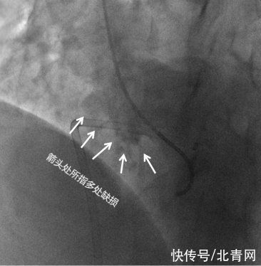 心室|罕见！台州32岁女子心脏有5个洞，怀孕体检时才发现，30多年前就有了