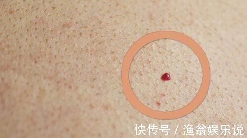 红痣|你的身上长有这种小红痣吗 一定不要大意!