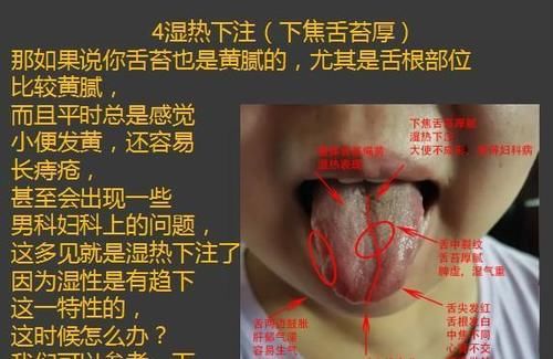 齿痕|齿痕重是脾虚，舌苔厚也是脾虚吗？怎样把舌苔变薄、齿痕消失呢？