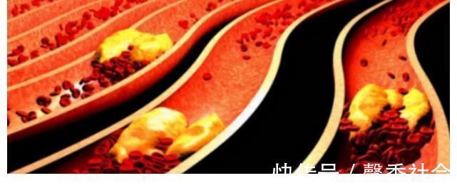 心血管医生|多走路可以降血脂？心血管医生：过了50岁，做好3件事更有效果