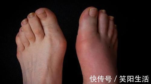 痛风|尿酸高的人不想痛风发作，4种食物尽早拉黑，别挑战身体极限！