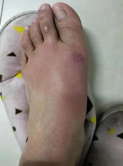 后果|全民护肤日：这些后果严重的皮肤病，却常常被忽视