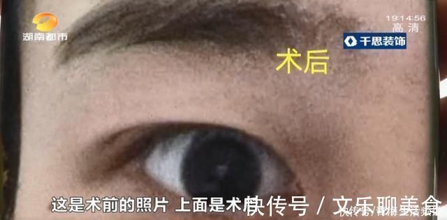 店家|女子花5800做双眼皮手术“变”单眼皮,欲退款遭拒,店家收据呢