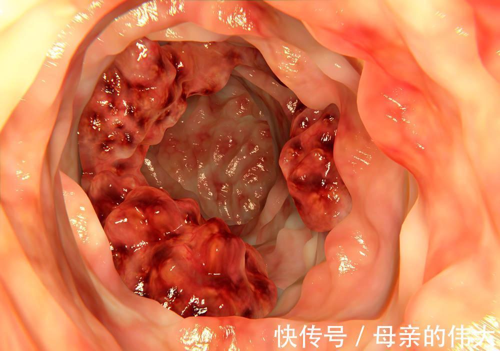 肠梗阻|夫妻俩前后3个月内确诊为直肠癌!只因这一饮食习惯,须警惕!