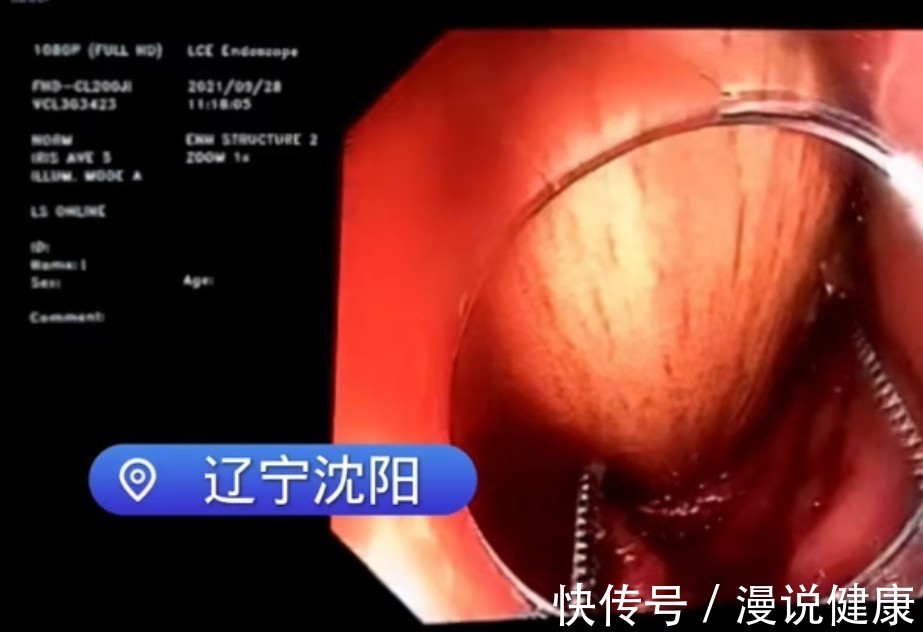 喝水|男子称因便秘将擀面杖塞入肠道:比起擀面杖,这3件事或更能通便