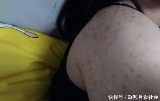 疙瘩|“过几天就要拍婚纱照，一胳膊的疙瘩好烦人”哈哈哈哈救命