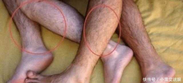 为什么有人腿毛旺盛,有人却“光溜溜”?女护士无奈说出实情