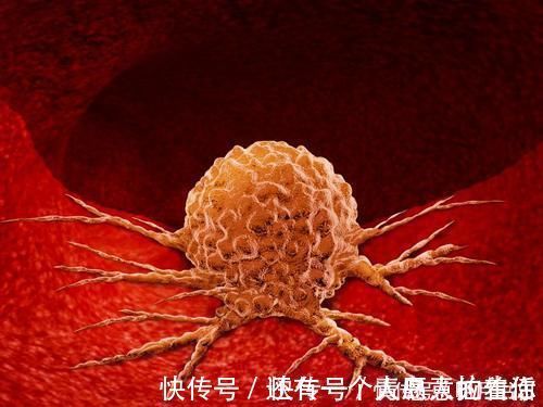 良性肿瘤|良性肿瘤可以不用动手术?告诫:4类良性肿瘤“不好惹”