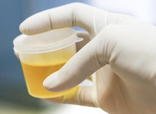 发黄|上厕所时尿液发黄,并伴有一股异味?医生建议注意下这6个方面