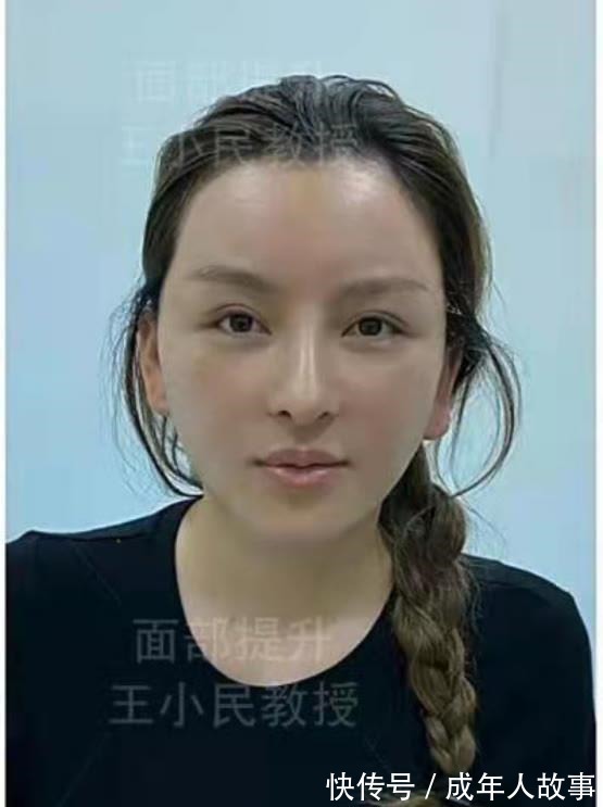拉皮 拉皮除皱王小民教授32岁做小拉皮,变化有多大!