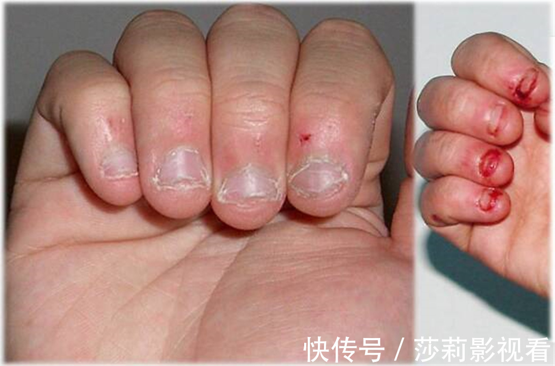 孩子|经常“啃指甲”的孩子,长大后往往逃不出这2种结局,父母要有数