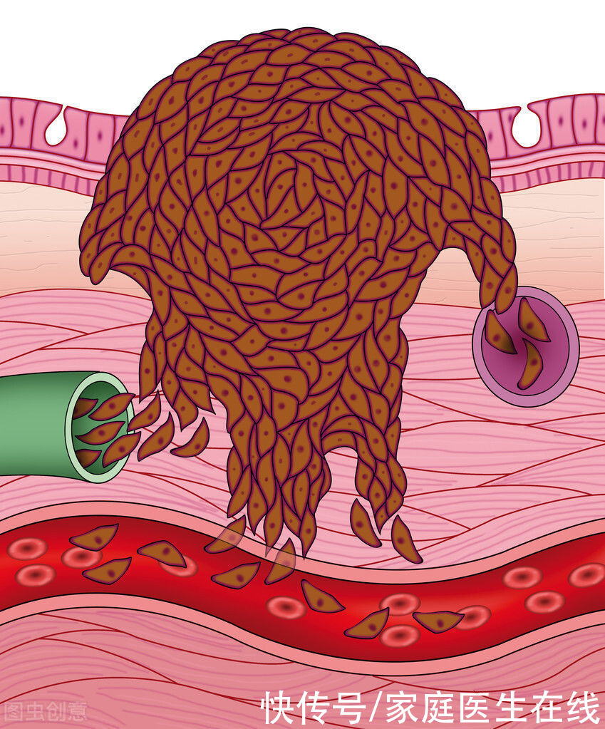 良性肿瘤_【良性肿瘤相关的图片和文章】( 1 )_草丁网
