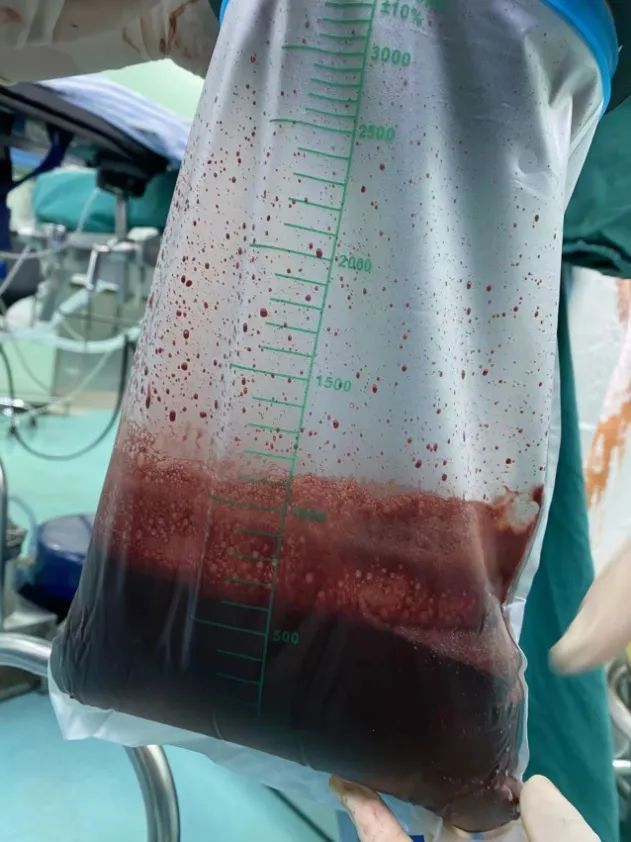 肚子疼|13岁女孩肚子疼想忍一忍,结果“忍”出一袋血