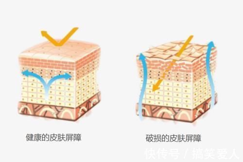 痘痘|有黑头、长痘痘怎么办？挤掉是下下策，这个方法不疼还省钱