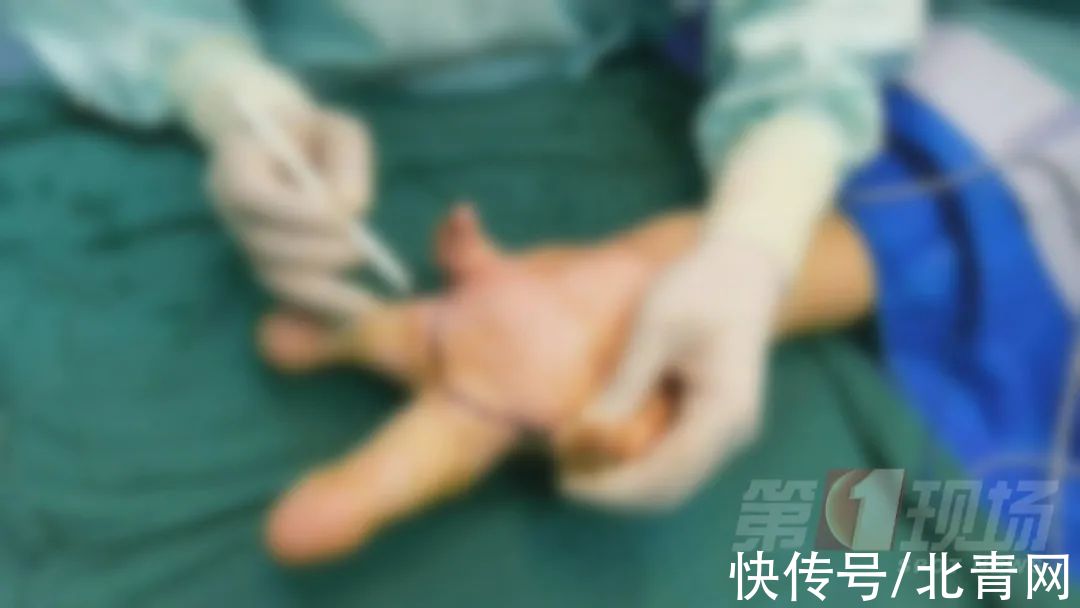 乐乐|双指粘连，12岁男孩手指比香蕉还粗！医生手术挽回手掌功能