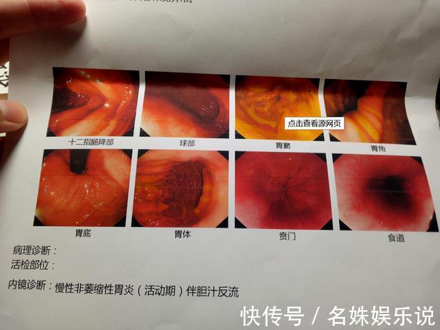 子宫肌瘤|别再被骗了!体检查出这些病都是小问题,很多人都在花冤枉钱