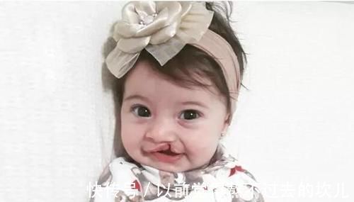 上唇腭裂|孕期胎儿频繁好动,孕妈以为孩子很健康,产检后医生:流产吧