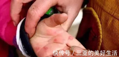 接种疫苗|今年将是手足口病的高峰年! 孩子出现这4个症状要及时就医！