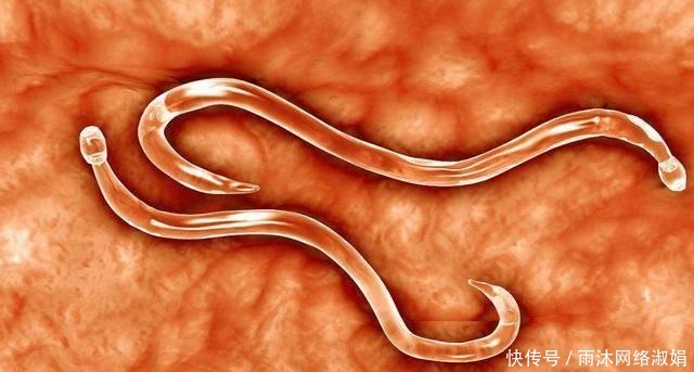 孩子|孩子出现这5种症状，要注意宝宝肚里可能长蛔虫啦