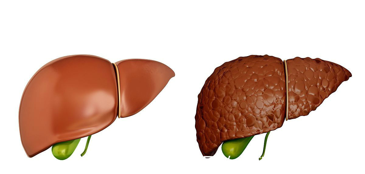 信号|身体出现三种信号，最好检查一下肝脏CT，肝癌可能已经找上你