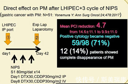 癌细胞|日本米村丰胃癌患者生存曲线:五年生存率达到47%!