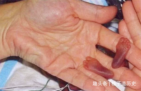 宝宝|14年前,那个打破吉尼斯世界纪录的“拇指宝宝”,后来怎样了