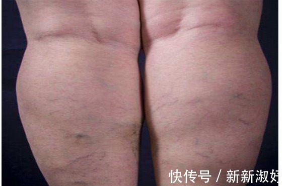 癌细胞|有没有癌，“腿”知道，若有以下3种异常，也许是癌细胞来访