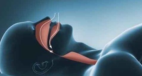 失眠症|凌晨3点左右自然醒来,就一直睡不着,或许是4种疾病在捣乱