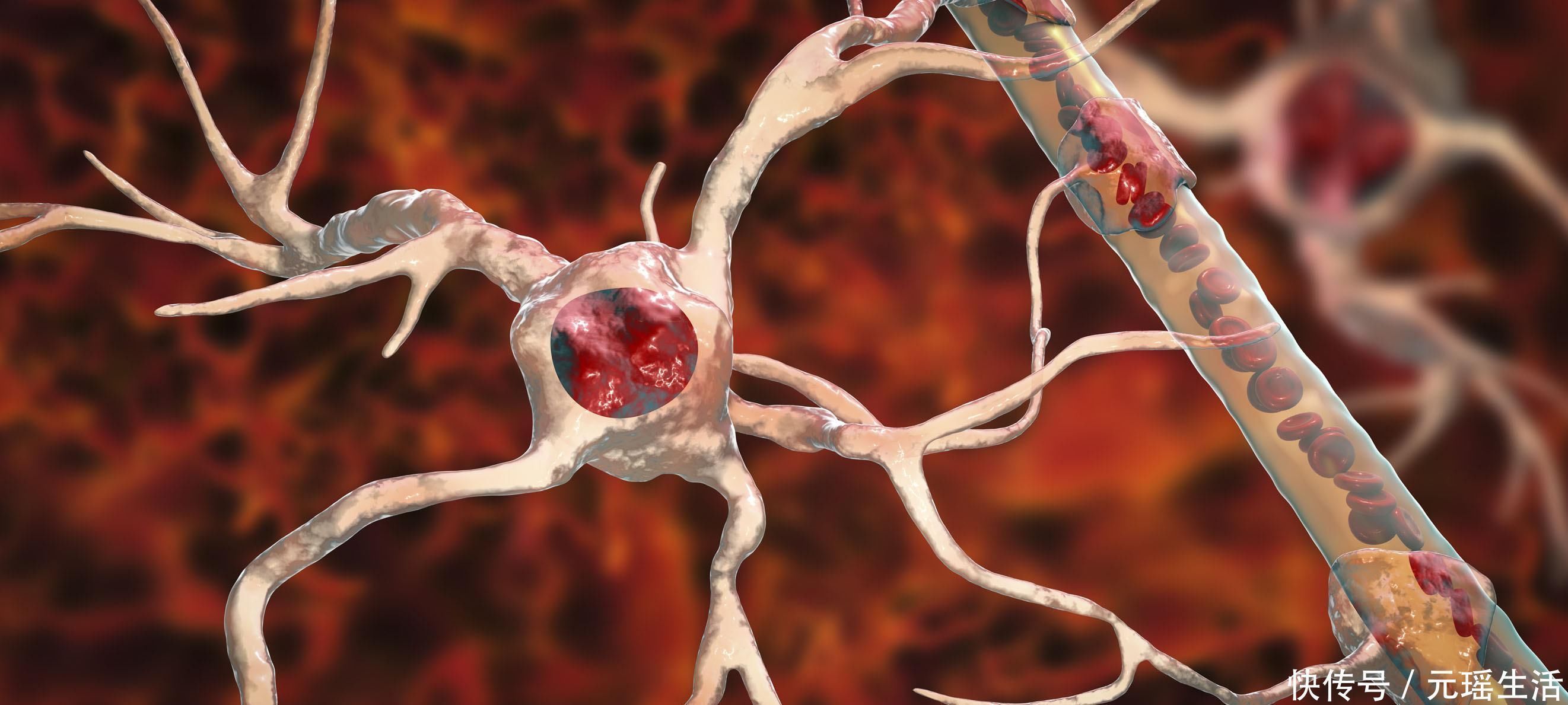 肺动脉栓塞|血管堵塞的人,身体3处会“疼痛”,坚持“五个一”,血液更畅通