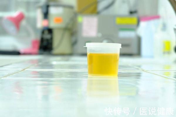上火|上厕所时,尿液发黄且异味重?或与这5个因素有关,及时检查
