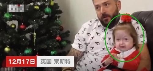 疾病|全球首例!2岁女童却有80岁的脸,网友:希望能像本杰明巴顿一样