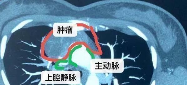 纵隔|32岁年轻妈妈前纵隔发现巨大肿瘤,手术风险高,要不要做