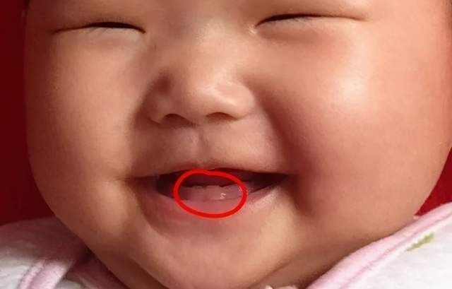 医生|宝宝一出生就有两颗牙齿,宝妈满心欢喜,医生却泼冷水:拔掉吧