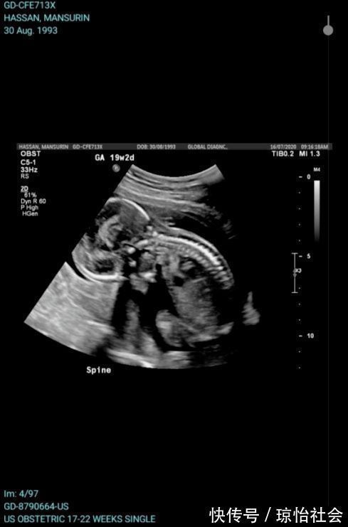 孕妇|震惊澳洲医院的一个操作,竟令婴儿胎死腹中!孕妇昏迷不醒!