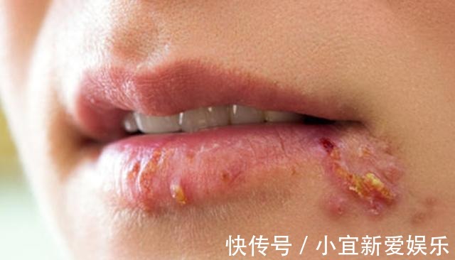 身体|嘴上长泡是身体在排毒吗?或许是暗示了这几个问题,别忽视