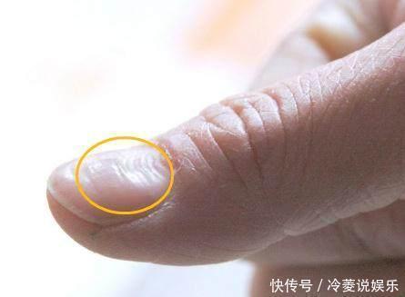 肝功能|不论男女，若手上没有这3个“标志”，恭喜，你的肝脏还很健康！