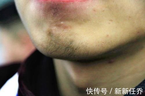 毛发|男人雄激素低，会给出哪些暗示？三点异常，算是比较突出的