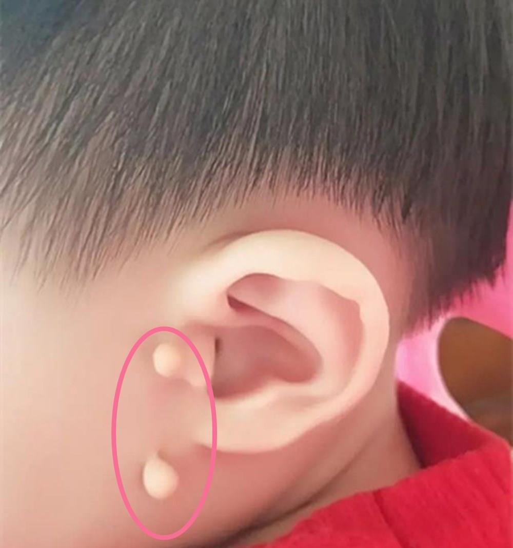 耳边多“肉揪”,孩子理发被嘲笑,耳有“拴马桩”是福气的象征?
