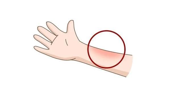 伤口|偏方治烫伤,6月娃不幸离世!孩子烫伤后,牢记5个字,能救命