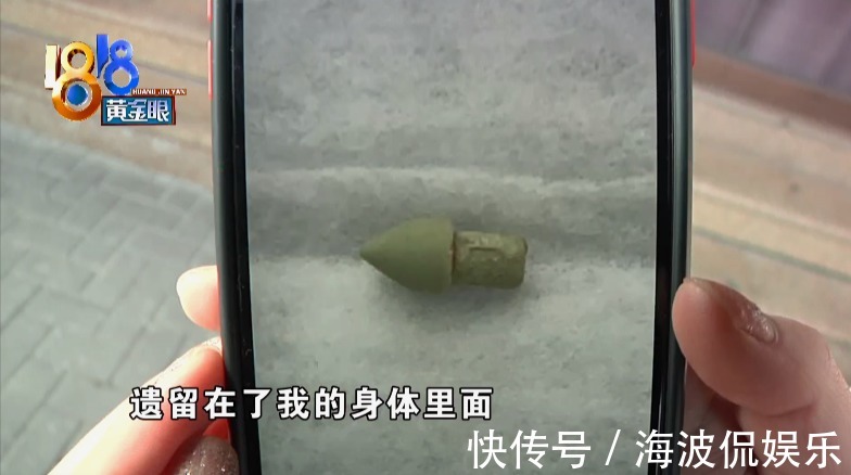 姑娘|吸脂术探头留在姑娘体内,院方两次手术都没取出