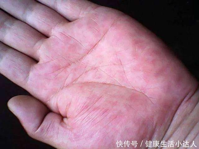 肝脏|肝脏有病，不易察觉？身体三处有异常，真的要好好查查肝了