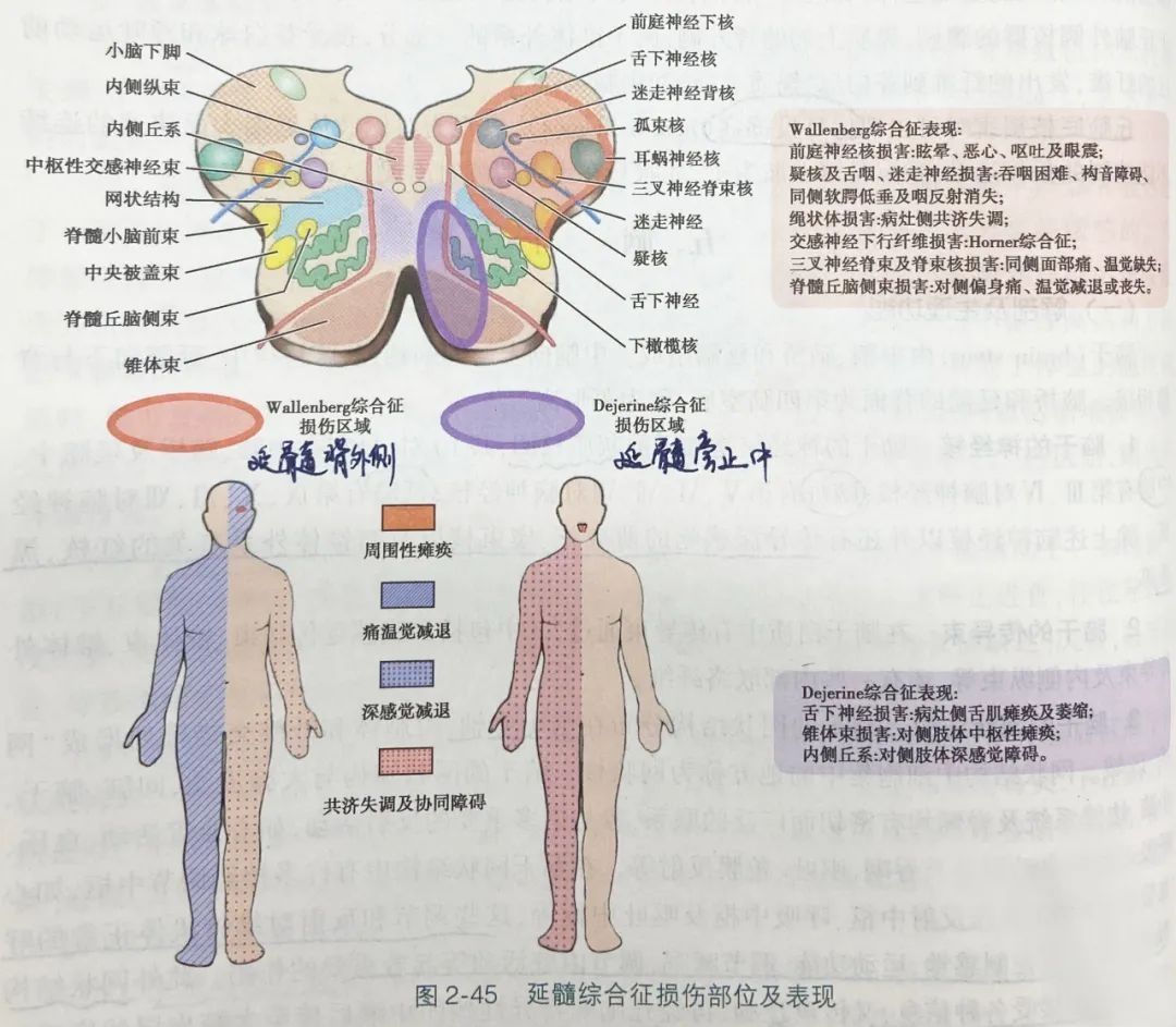 受损|脑干内 vs 脑干外病变，临床如何鉴别？