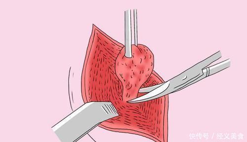 恶性|肿瘤患者,能满足3个条件,值得恭喜,治疗效果还不错