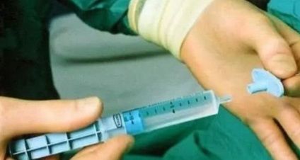 麻醉|为什么剖腹产大多是局麻，人流却用全麻？可能是这个原因！